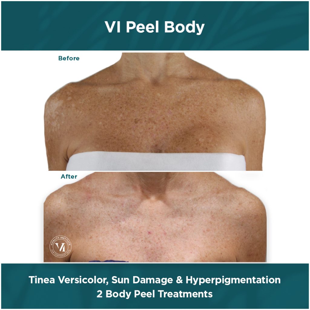 Tina Versicolor, Sun Damage & Hyperpigmentation (1)