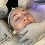 Cleopatra Hydrodermabrasion