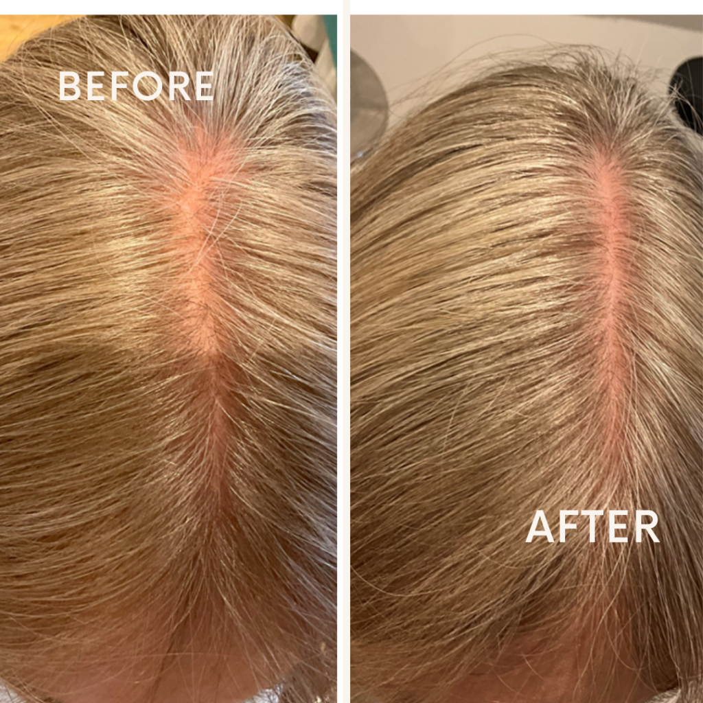 Crown improvement