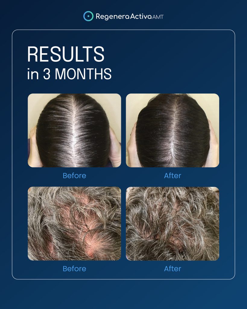 Regenera Restuls in 3 months