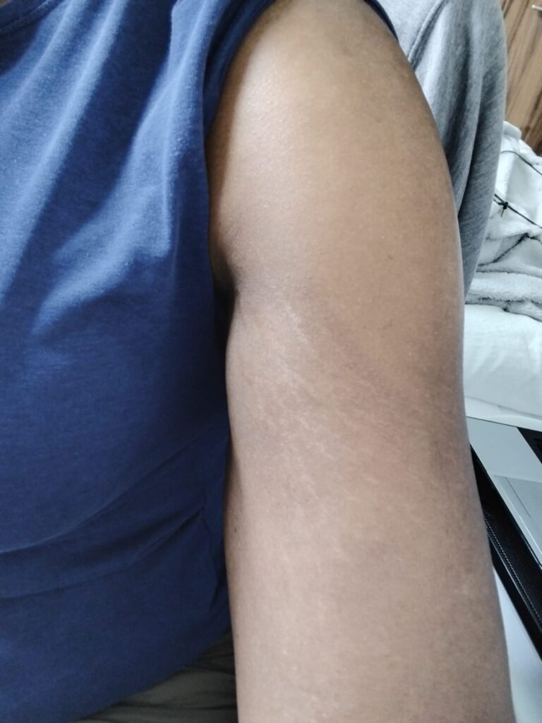 1 month after treatment 1