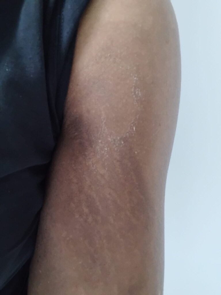 13 days after treatment 1