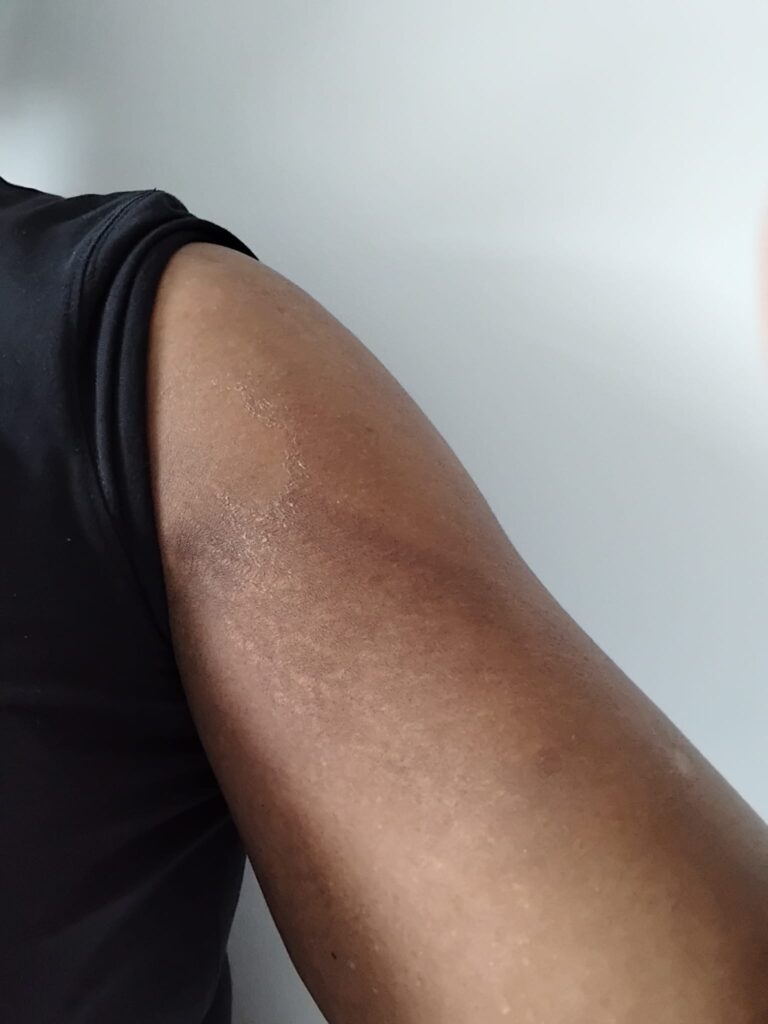 13 days after treatment 1