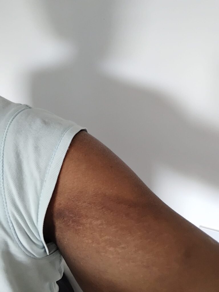 2 days after treatment