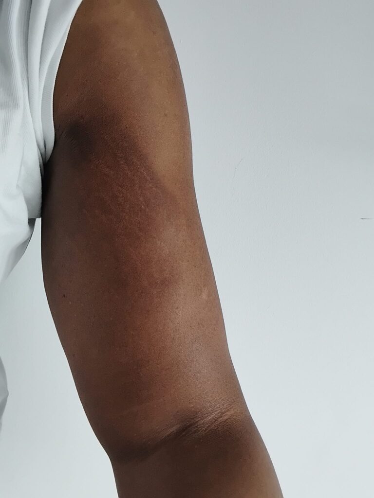 3 days after treatment