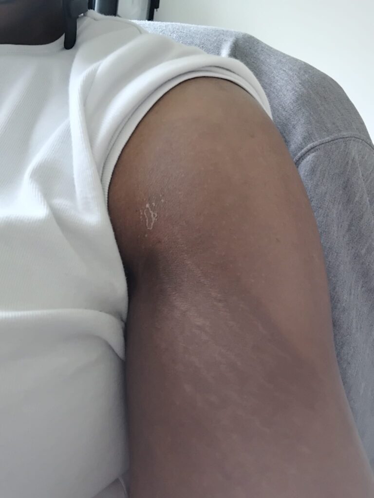 4 days after treatment