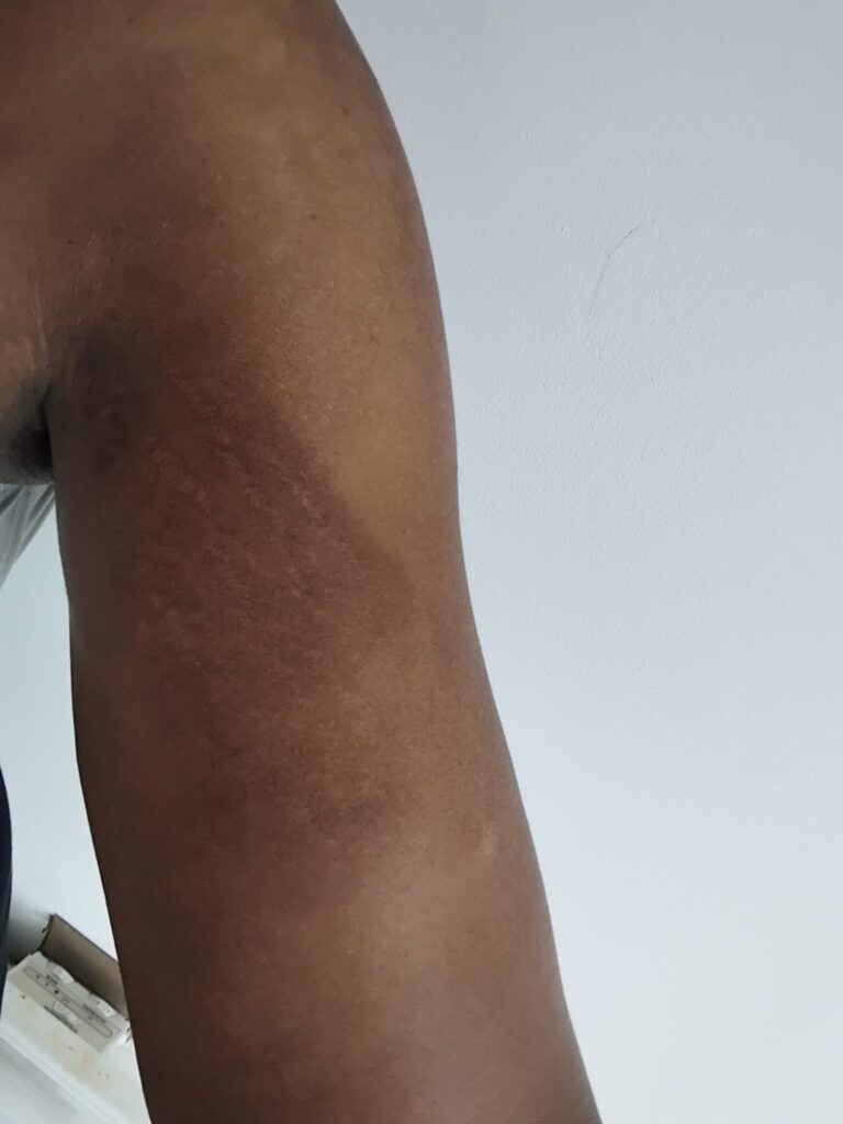 5 days after treatment