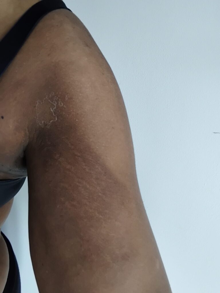 6 days after treatment