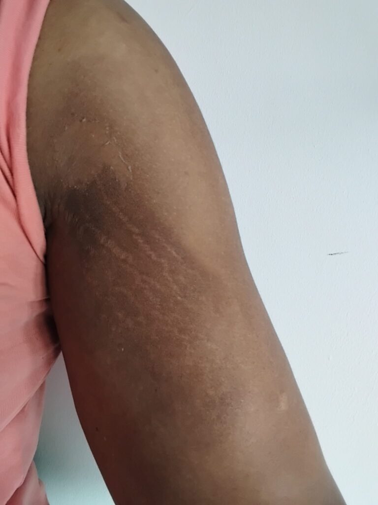 7 days after treatment