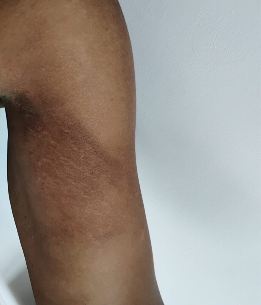 Day 1 after first treatment (same appearance as before treatment)