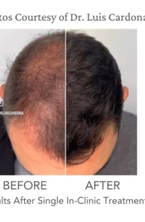 Half head picutre of man withthin hair on one side and denser hair on another side