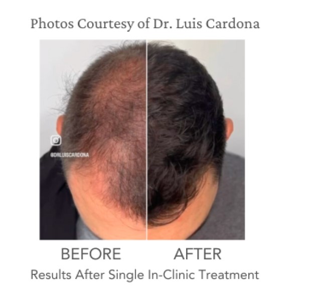Half head picutre of man withthin hair on one side and denser hair on another side