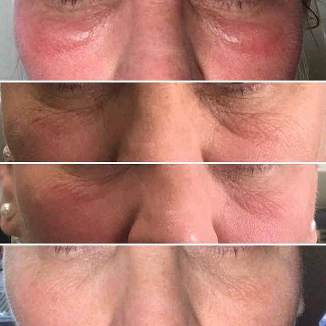 @purehairbeautydalby - 2 treatments in 2 days