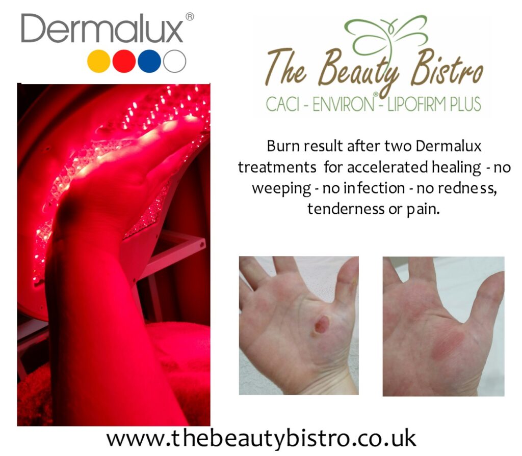 Before and After Burn