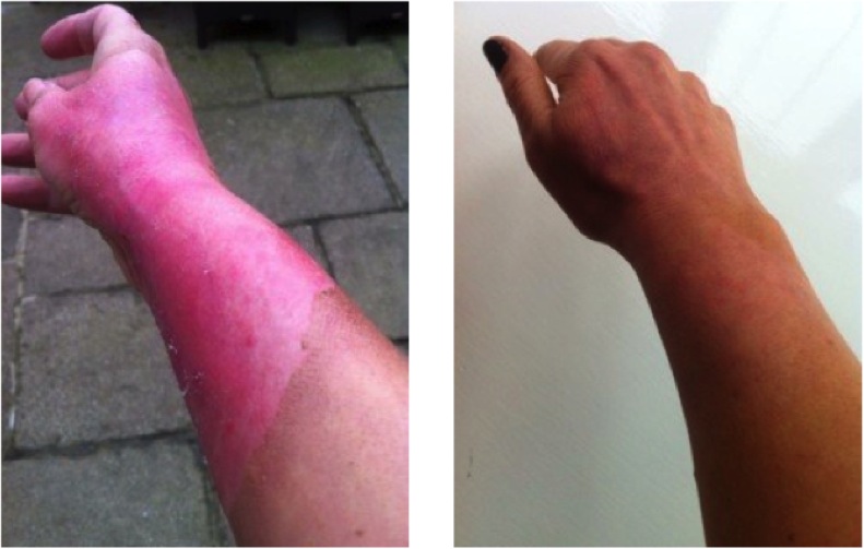 Before and After Scald Burn