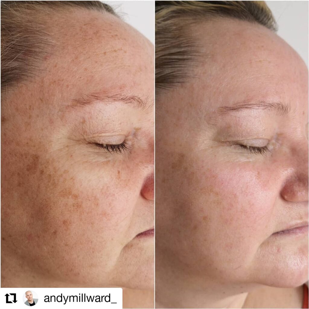 Flex MD Pigmentation