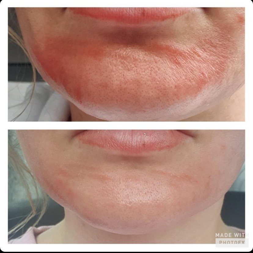 Post Treatment Healing