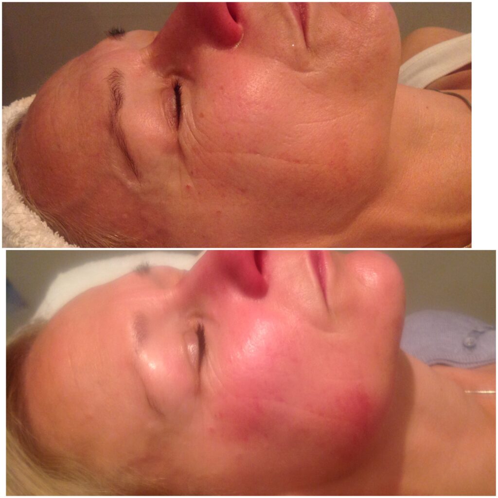Skin Rejuvenation Before and Immediatley After_ Dermalux and Skin Peel