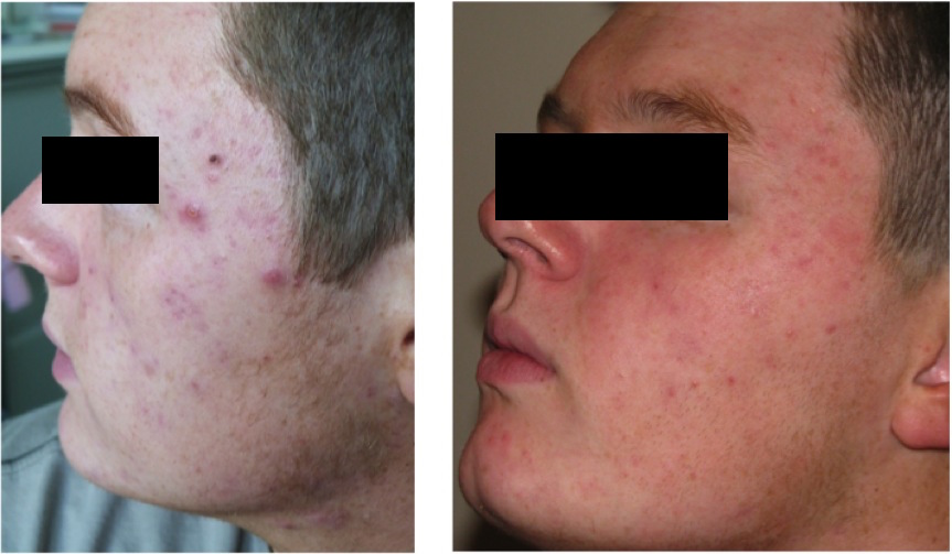 Spots Before and After 1