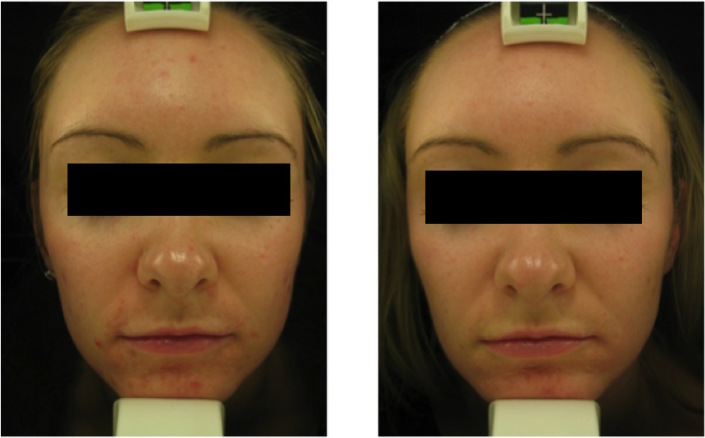 Spots Before and After