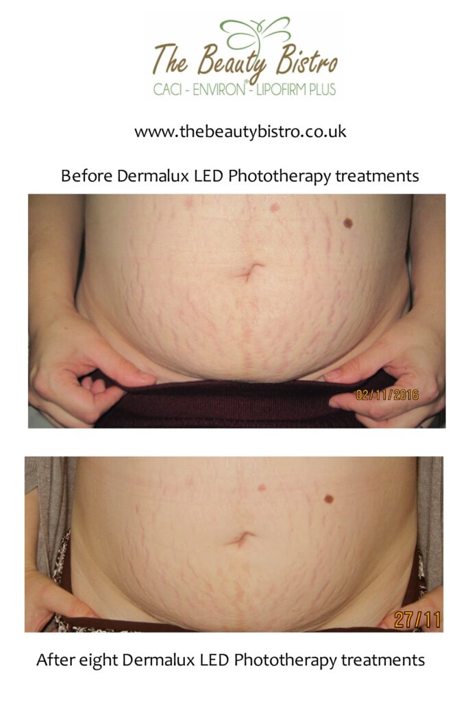 Treating Stretch Marks